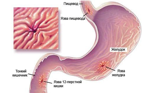 Эритематозный экссудативный пангастрит встречается редко