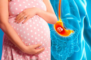 Беременная девушка и гастрит желудка в организме картинка
