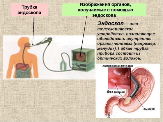 Эндоскоп при инородном теле в организме 